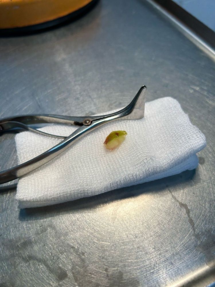 Случай  выходного дня: Малыш и яблоко в носу!