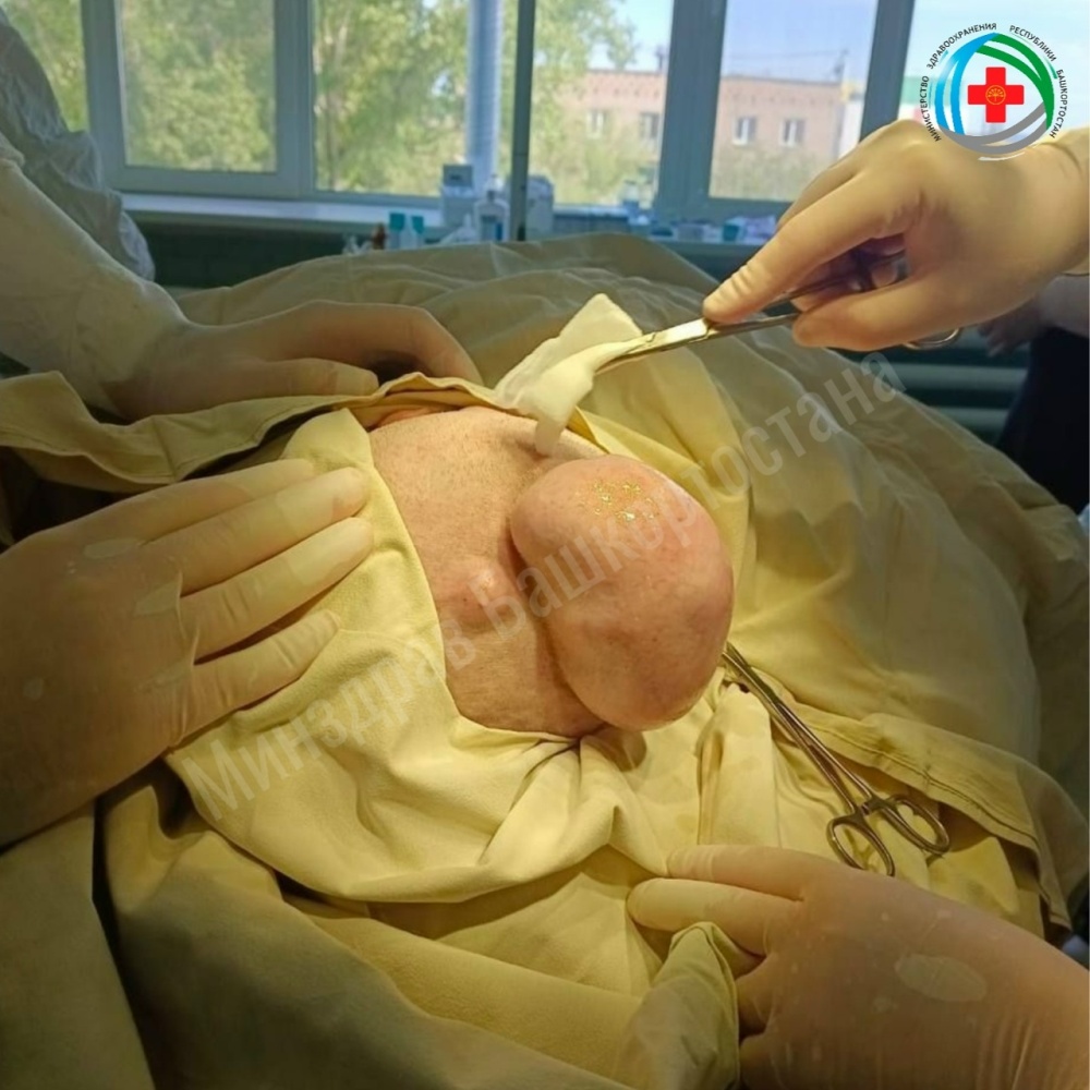 Врачи Бирской больницы удалили огромное новообразование у 77-летней женщины